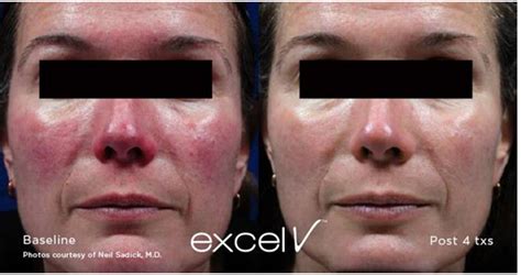 Dr. Yekaterina Kleydman | Rosacea Treatment - Kleydman Dermatology