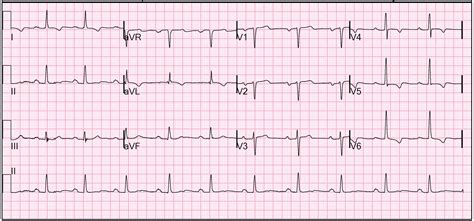 How To Read A 12 Lead Ecg - unugtp