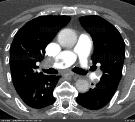 STOCK IMAGE, acute pulmonary embolism blood clots of the right and left pulmonary arteries chest ...