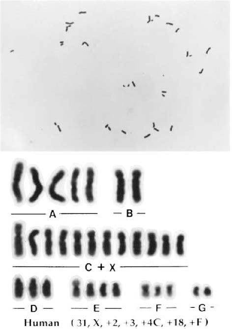 An aneuploid karyotype derived from a spermatozoon with a large head (n... | Download Scientific ...