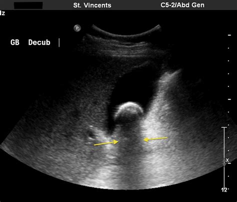 Gallbladder Stones Ultrasound | Sexiz Pix