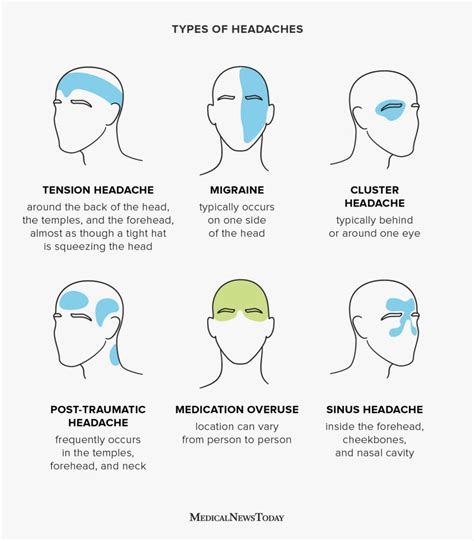 Headache chart: Types by symptoms, location, and causes