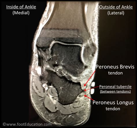 Peroneal Tendonitis - FootEducation