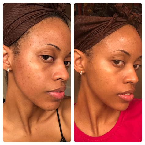 [B&A] 2 month hyperpigmentation progress: Vitamin C in the AM Personal ...