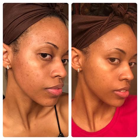 [B&A] 2 month hyperpigmentation progress: Vitamin C in the AM Personal microdermabrasion once ...