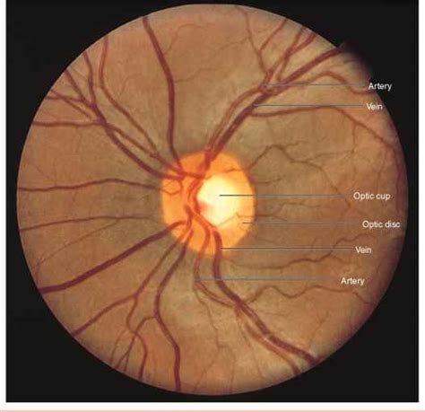 Normal Optic Disc - Physical Diagnosis - Mitch Medical Healthcare