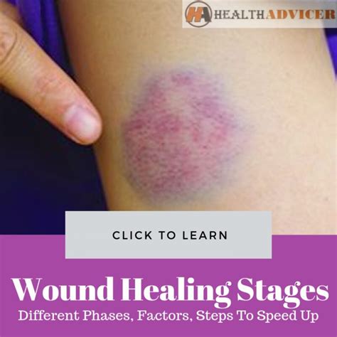 Wound Healing Stages: Different Phases, Factors, Steps To Speed Up