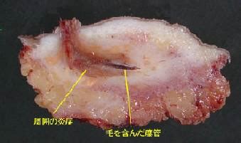 Pathology Lab Pictures - Pilonidal Support Alliance