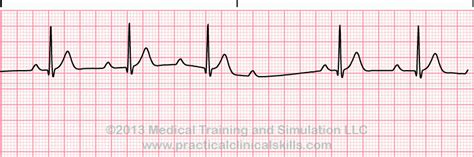 Conduction Disorders (PEARLS) | SMARTY PANCE