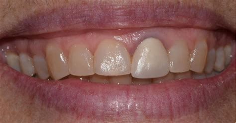 Dental Before & Afters | Woburn Dental Associates