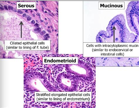 Serous Ovarian Cancer Histology - CancerWalls