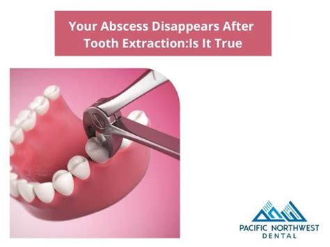 What Happens to Your Abscess After Tooth Extraction?