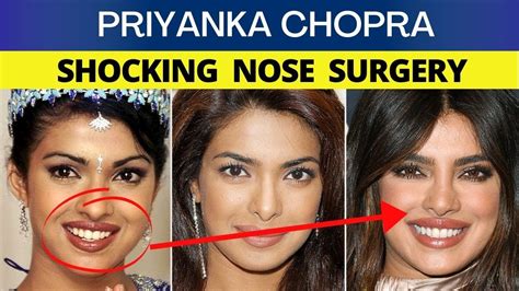 Priyanka Chopra Nose Job Before