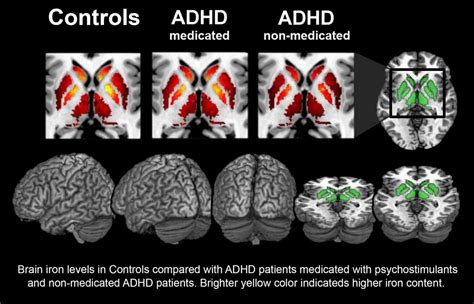 Charleston scientists study iron levels in brain to diagnose ADHD in ...