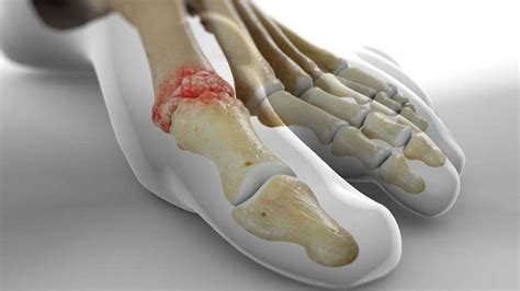 Cheilectomy - California Orthopaedic Specialists