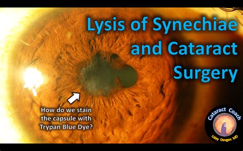 Lysis of Synechiae and Cataract Surgery – Cataract Coach