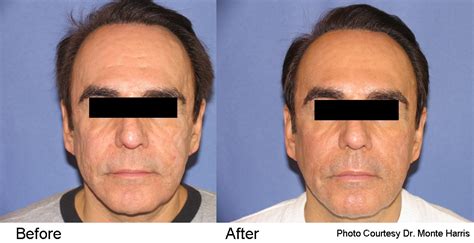 For Men - Liquid Lunchtime Facelifts