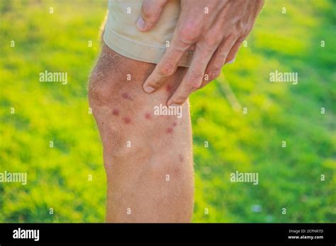 Sand fly bites hi-res stock photography and images - Alamy