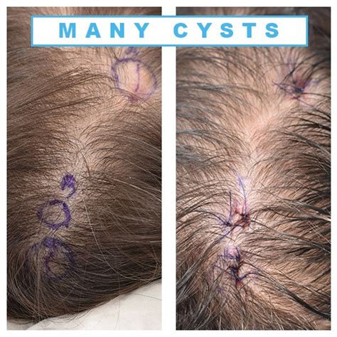 Epidermoid Cyst Scalp