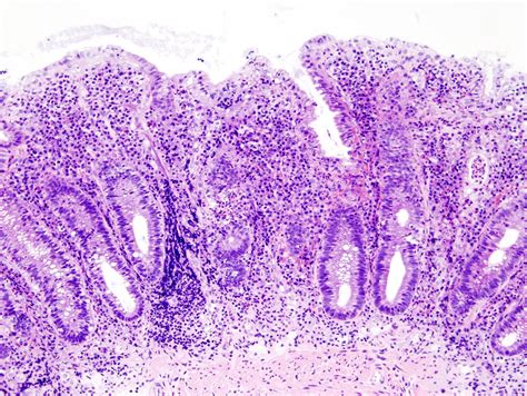 BMS’ deucravacitinib fails to meet efficacy goals in ulcerative colitis trial