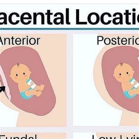 Pregnancy | Moms | Postpartum on Instagram: "Anterior Placenta: When the placenta is attached to ...