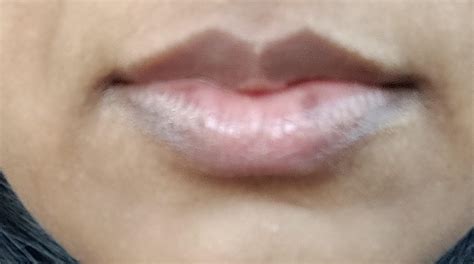 [Sun Care] Need help with sun spots and discoloration on lips : SkincareAddiction