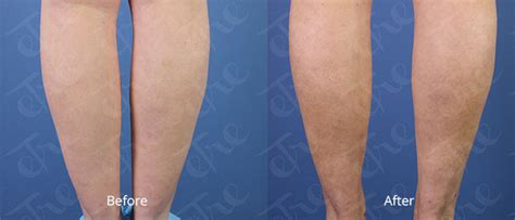 Laser Liposuction New Orleans | Minimally Invasive Fat Removal | Être