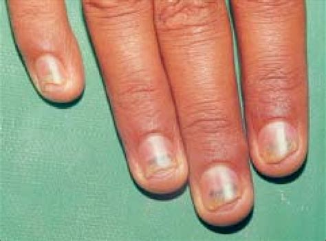 Onycholysis of all finger nails | Download Scientific Diagram