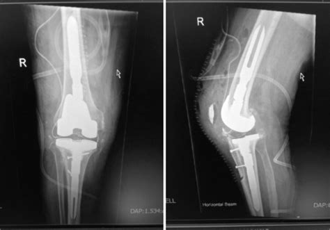 Tibial Tubercle Osteotomy in Revision Knee Arthroplasty - The Journal of Arthroplasty