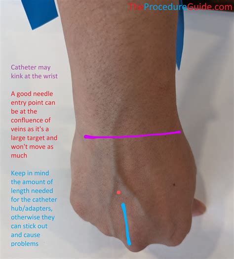 Peripheral Intravenous Access (IV) – Technique and Overview - The ...