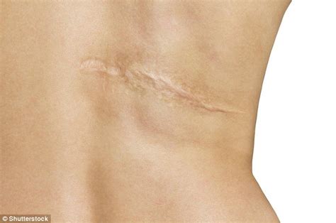 How you can soothe your painful scars by simply STROKING THEM | Daily ...