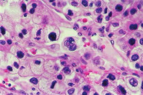 Malignant leydig cell tumor: pronounced nuclear and cellular... | Download Scientific Diagram