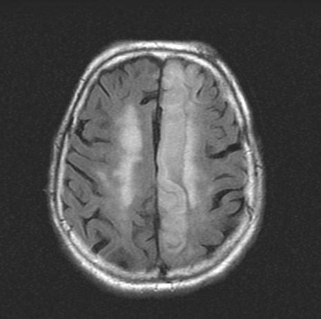 Ischemic stroke MRI - wikidoc