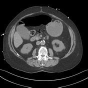 Acute cholangitis | Radiology Reference Article | Radiopaedia.org