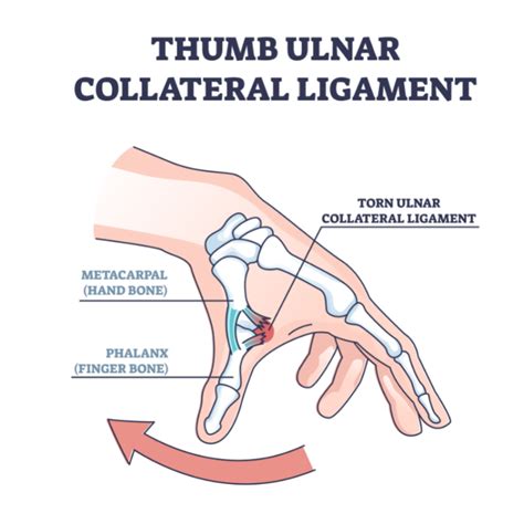 What is Skier's Thumb? | Orthopedic Doctors in Bend, Oregon