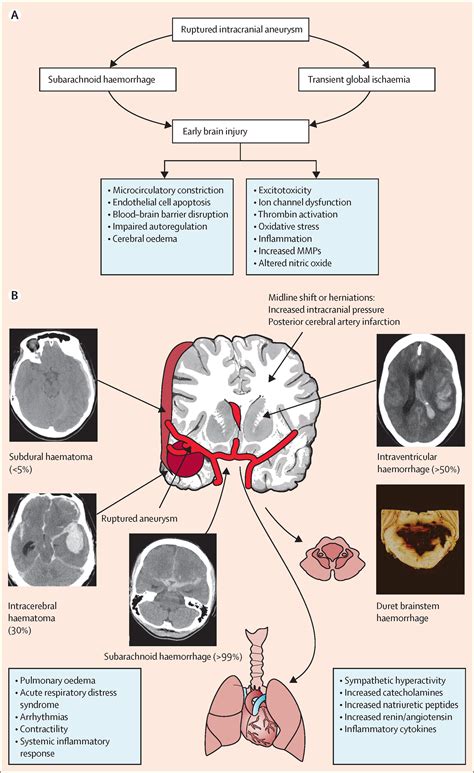 Spontaneous subarachnoid haemorrhage - The Lancet