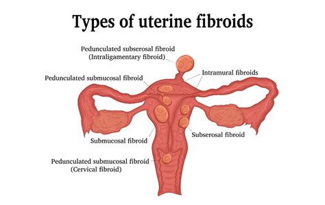 What Is Fibroid Degeneration? | USA Fibroid Centers