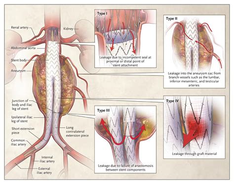 Abdominal Aortic Aneurysm Repair