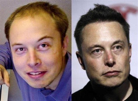 Did Elon Musk Get a Hair Transplant? - Before and After | PMHR - Parsa ...