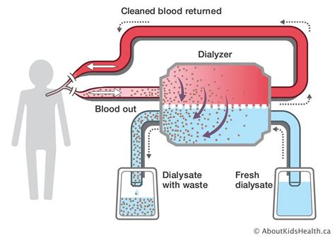 Hemodialysis