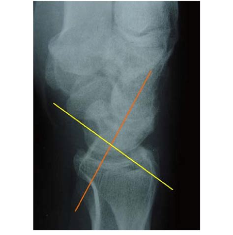 DISI deformity: Scapholunate angle >60° | Download Scientific Diagram