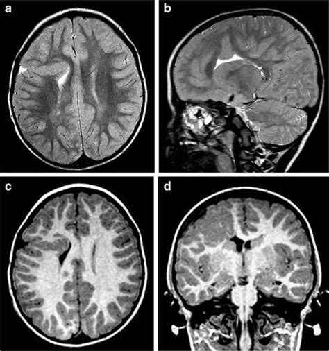 Schizencephaly causes, symptoms, diagnosis, treatment & prognosis