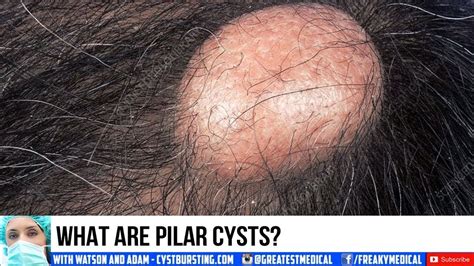 Pilar Cysts, Scalp Cysts, Cyst Pops and Dermatology - YouTube