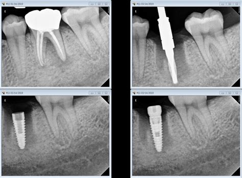 Dental Implants Toronto | Dental Implants Near Me Toronto | Carlton Dental Toronto