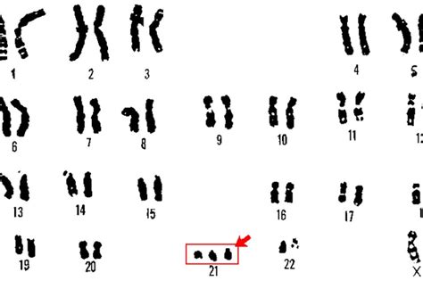 Shutting Down the Extra Chromosome in Down’s Syndrome Cells