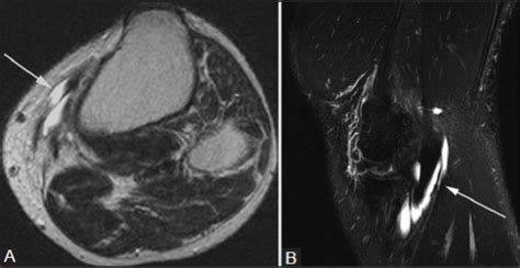 Pes anserine bursitis. A 30-year-old male with medial k | Open-i