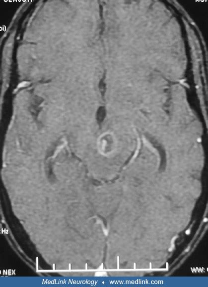 Cerebral toxoplasmosis | MedLink Neurology