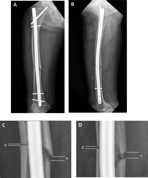 Im Nailing Hip Fracture - Nail Ftempo