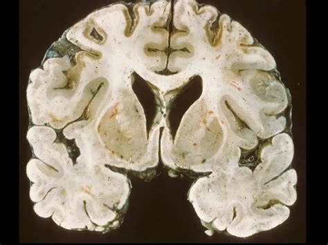 Acute hypertensive encephalopathy: symptoms, diagnosis, treatment ...