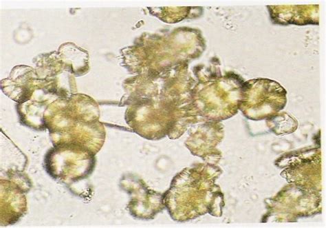 Sulfa Crystals In Urine | www.imgkid.com - The Image Kid Has It!